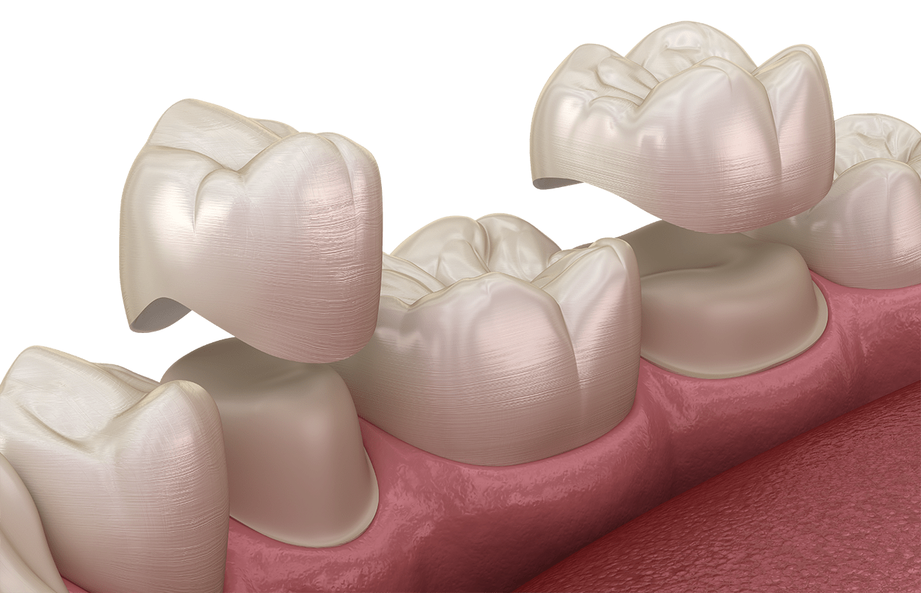 Image 3D d'une couronne dentaire