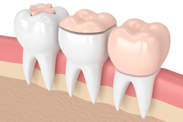 3 dents avec les 2 façons de réparer une dent : inlay, onlay et couronne