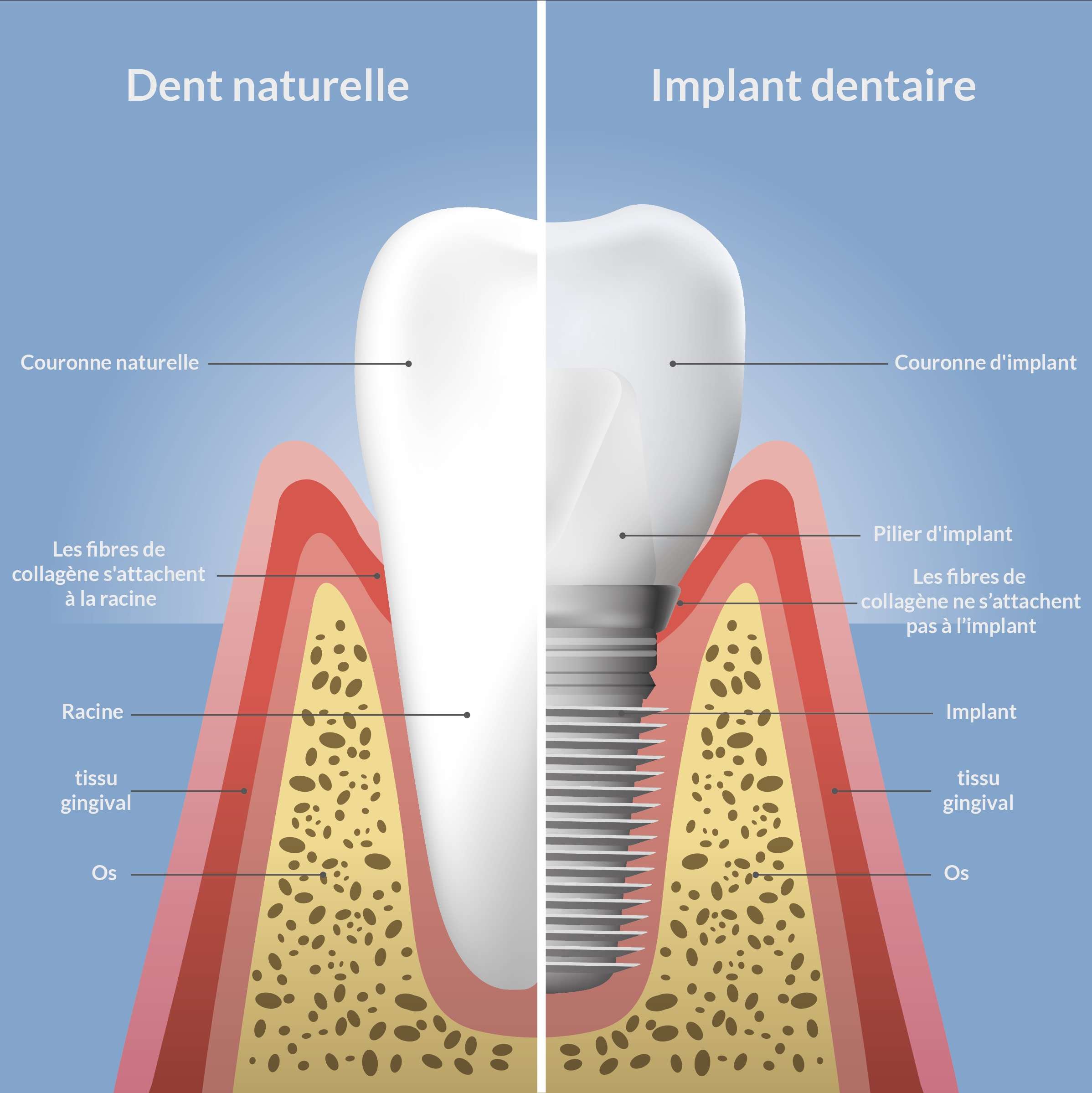 implant-dentaire-gloriette-1